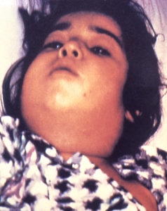 child with diphtheria presented with a characteristic swollen neck, sometimes referred to as “bull neck”. Diphtheria is an acute bacterial disease involving primarily the tonsils, pharynx, larynx, nose, skin, and at times other mucous membranes. The mucosal lesion is marked by a patch or patches of an adherent grayish membrane with a surrounding inflammation.